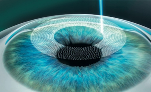 Bladless Lasik surgery